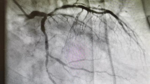 22岁女孩熬夜加班猝死最终没救回（又是猝死22岁女孩）(5)