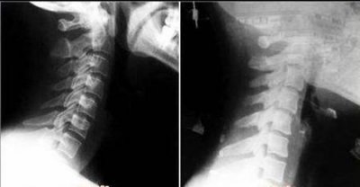 ​有颈椎病怎么睡觉比较好(颈椎病睡觉的正确睡姿)