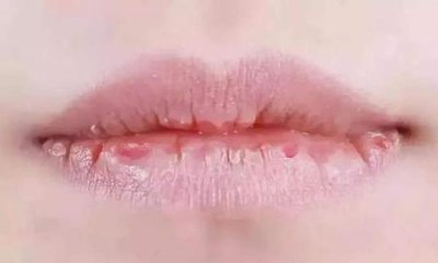 ​嘴巴干涂口红起皮怎么办(图上口红嘴唇起皮怎么办)
