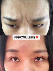 ​去掉川字纹方法（如何去掉川字纹）