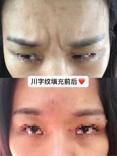 去掉川字纹方法（如何去掉川字纹）